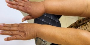 乳腺癌手术后多年手臂淋巴水肿？骆成玉线上挂号看这里！
