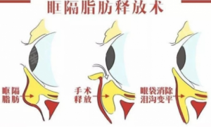 北京好年华：眶隔脂肪释放与吸脂有什么不同