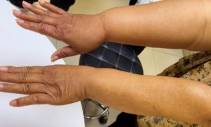 乳腺癌手术后多年手臂淋巴水肿？骆成玉线上挂号看这里！